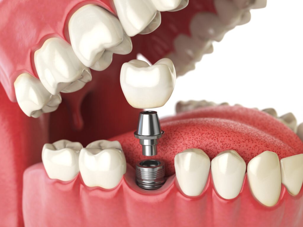 Best Dental Clinic in Ravet? Visit The Family Dental Clinics for affordable, expert dental care personalized approach.