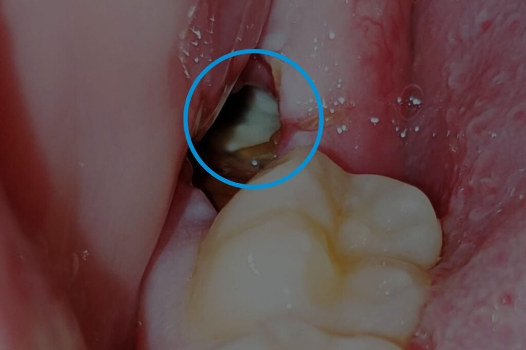 Experience stress-free wisdom teeth removal at The Family Dental Clinics. Expert care, minimal discomfort, and fast recovery!
