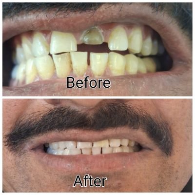 Experience stress-free wisdom teeth removal at The Family Dental Clinics. Expert care, minimal discomfort, and fast recovery!
