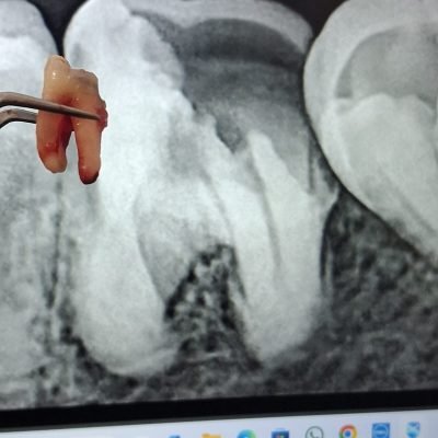 Experience stress-free wisdom teeth removal at The Family Dental Clinics. Expert care, minimal discomfort, and fast recovery!