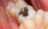 Amalgam Fillings (Silver) Amalgam Fillings (Silver)