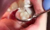 Cavity Fillings & Restorations Cavity Fillings & Restorations