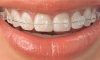 Ceramic Braces