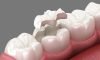Ceramic Fillings (Porcelain) Ceramic Fillings (Porcelain)