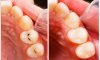 Composite Fillings1 Composite Fillings1