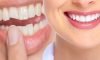 Dental Bonding