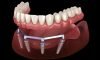 Full-Arch Implants (All-on-4) Full-Arch Implants (All-on-4)