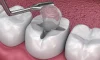 Glass Ionomer Fillings Glass Ionomer Fillings
