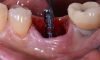 Immediate Implants Immediate Implants