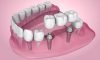 Implant-Supported Bridges Implant-Supported Bridges