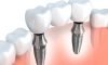 Implant-Supported Crowns & Bridges
