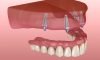 Implant-Supported Dentures