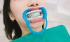 In-Office Whitening