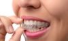 Invisalign & Braces