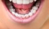 Lingual Braces
