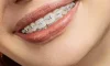 Metal Braces