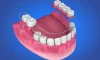 Partial Dentures