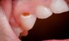 Pediatric Root Canal (Pulpectomy)