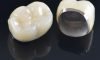 Porcelain-Fused-to-Metal (PFM)