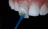Porcelain Veneers
