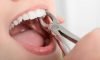 Experience stress-free wisdom teeth removal at The Family Dental Clinics. Expert care, minimal discomfort, and fast recovery!