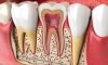 Retreatment Root Canal