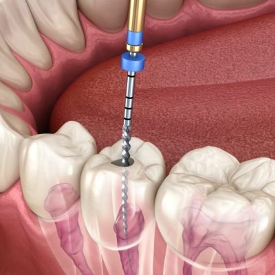 Discover more about our Dental Clinic in india—expert care, advanced technology, and a patient-first approach for all ages.