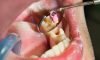 Experience stress-free wisdom teeth removal at The Family Dental Clinics. Expert care, minimal discomfort, and fast recovery!