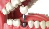 Best Dental Clinic in Ravet? Visit The Family Dental Clinics for affordable, expert dental care personalized approach. Best Dental Clinic in Ravet? Visit The Family Dental Clinics for affordable, expert dental care personalized approach.